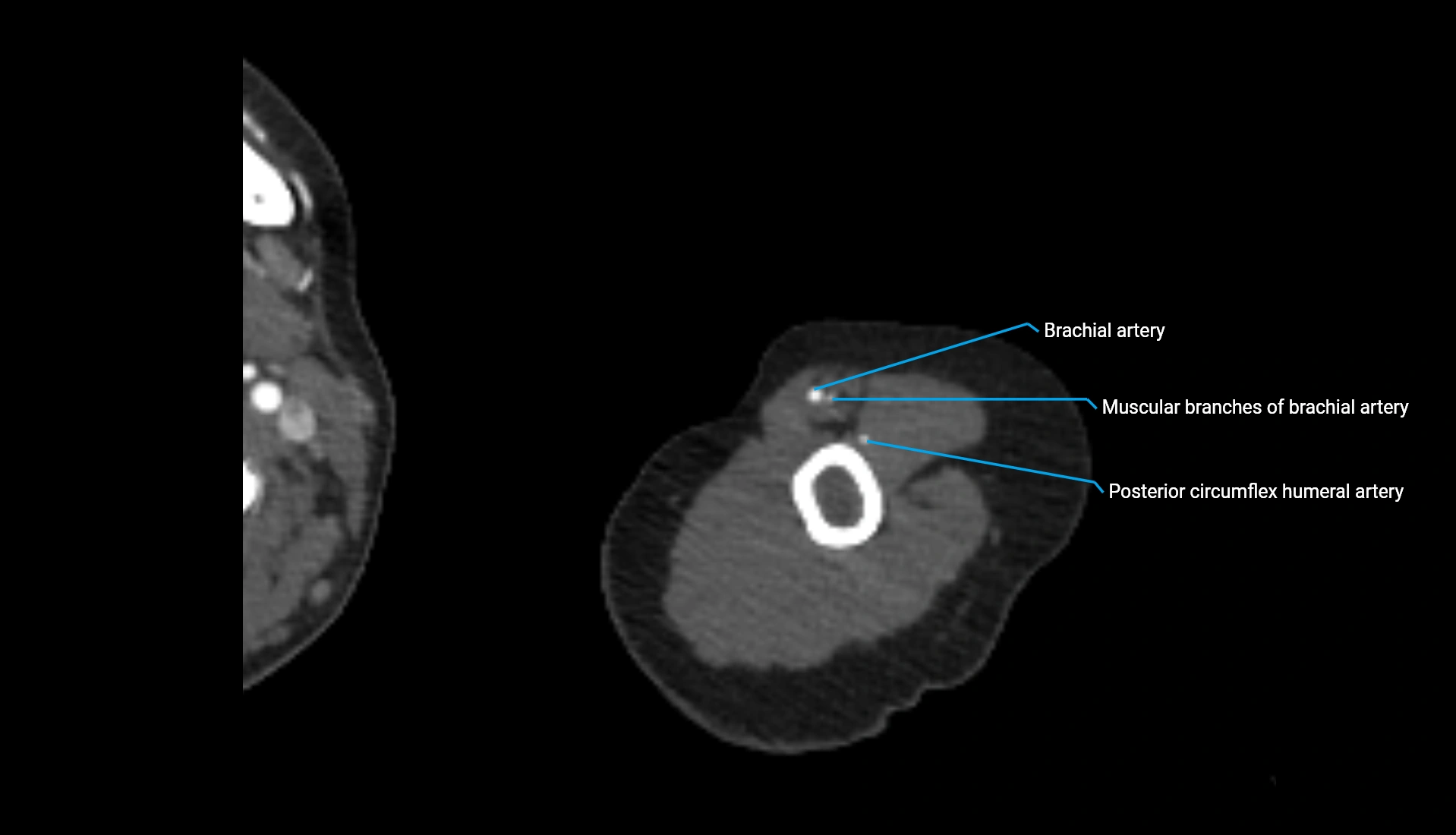 CTA upper limb axial cross sectional anatomy labelled image 297 (2).webp